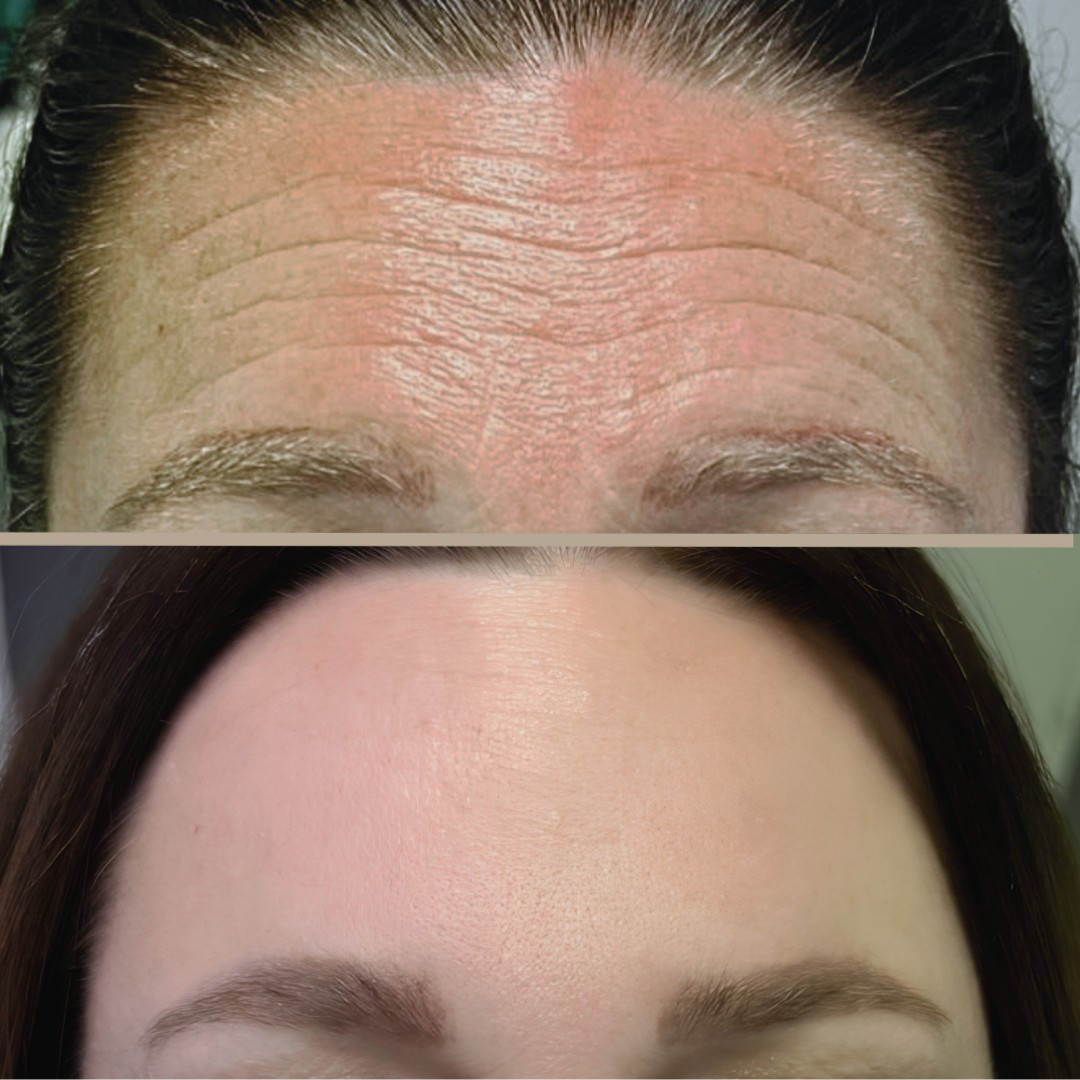 CASE STUDY – BOTULINUM TOKSIN